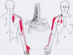 Синдром лестничной мышцы. Лечение через триггерные точки