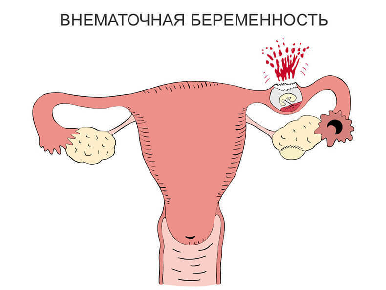 Первая помощь при внематочной беременности