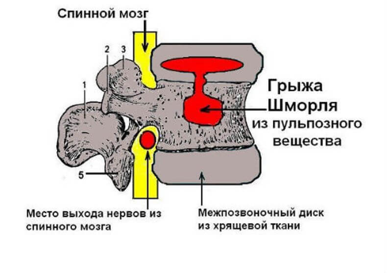  Грыжа Шморля: чего стоит опасаться