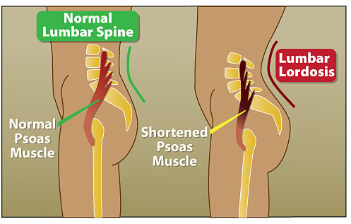 Ключ к мышцам кора: поясничная мышца (psoas)