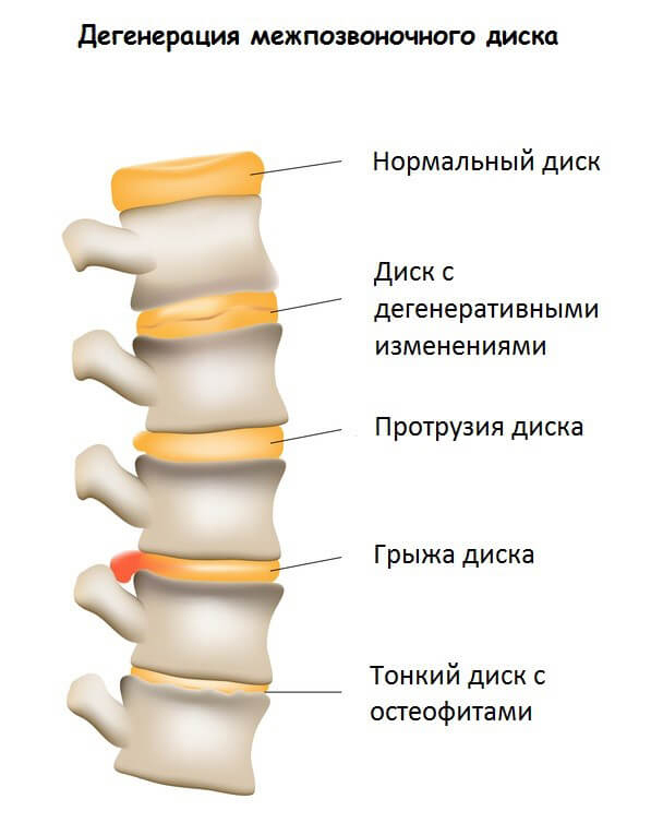 Симптомы протрузии диска, о которых вы обязаны знать