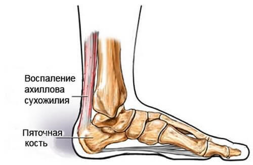 Упражнения при воспалении ахиллова сухожилия