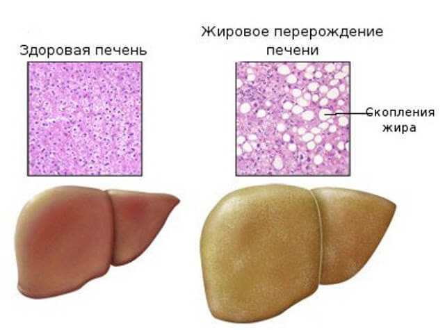 Лептинорезистентность и жировая болезнь печени