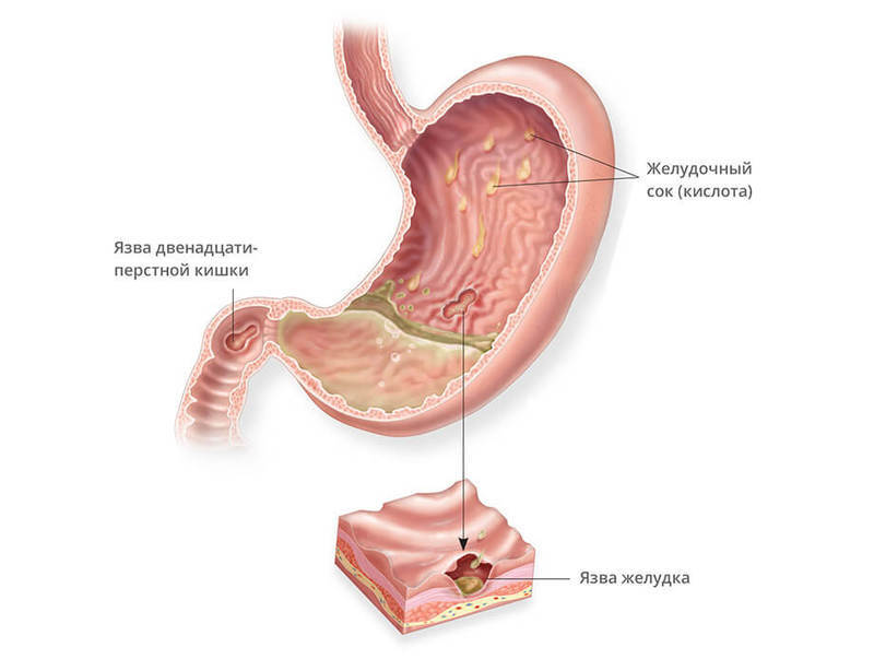 Лечение язвы желудка по методу Марвы Оганян