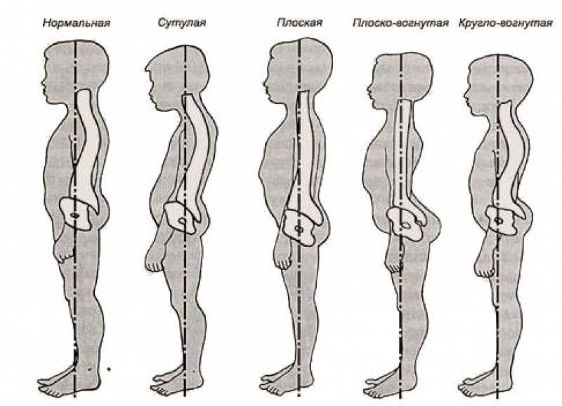 Как плаванием исправить нарушения осанки