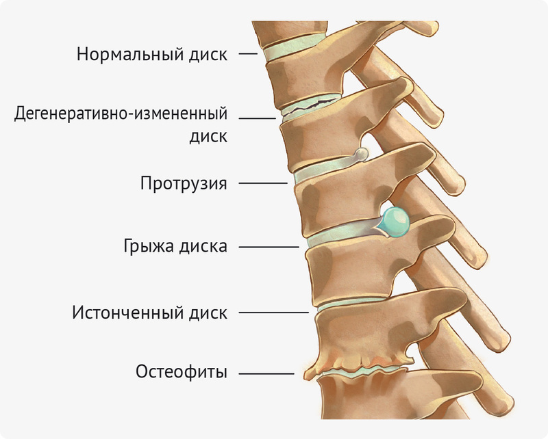 Заболевания межпозвонковых дисков: вопросы и ответы