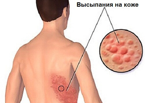 Опоясывающий лишай: лечение натуральными средствами