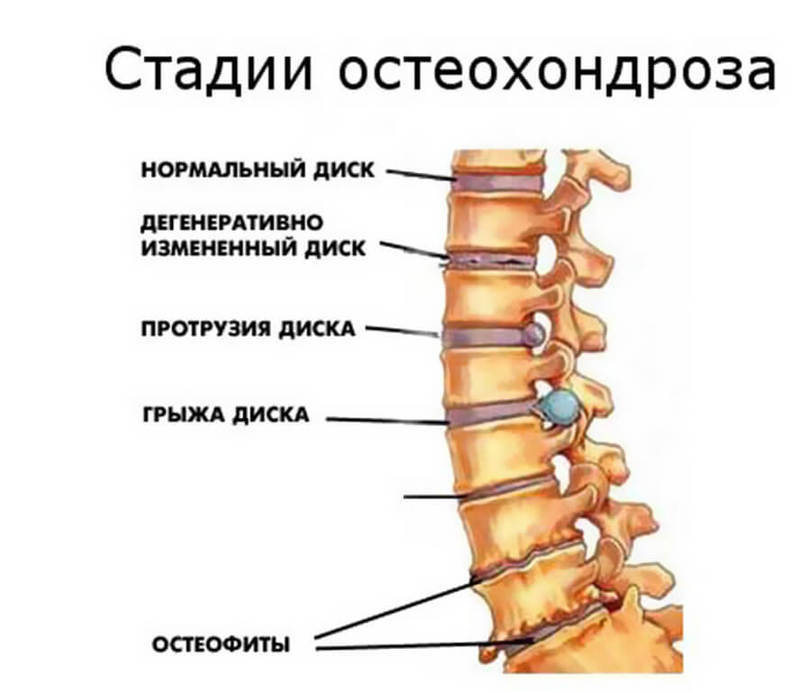 Остеохондроз — расплата за непонимание собственного организма