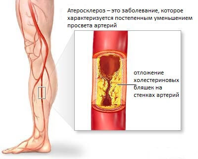 Атеросклероз сосудов ног: тревожные симптомы 