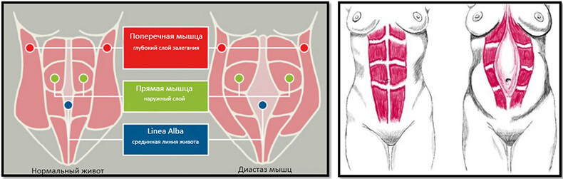 Диастаз прямых мышц живота: Кто виноват и что делать