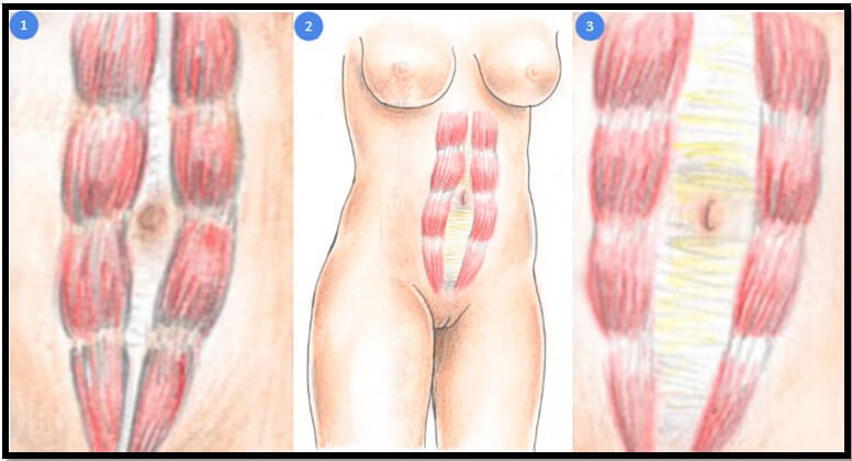 Диастаз прямых мышц живота: Кто виноват и что делать