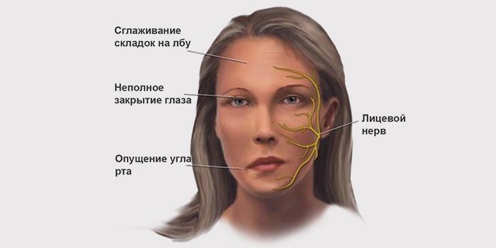 Лечебная гимнастика при НЕВРИТЕ лицевого нерва