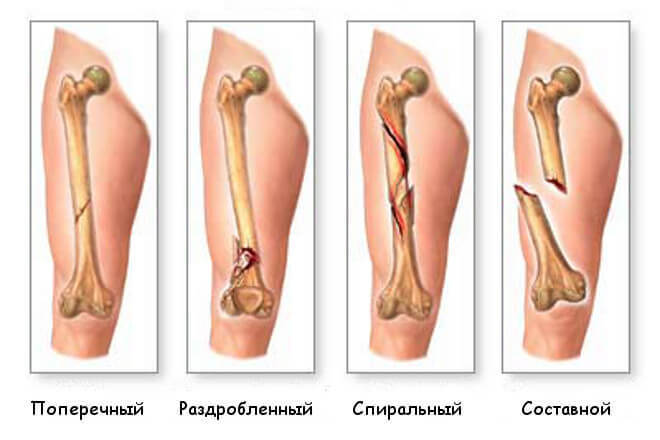 Эффективные упражнения при плоскостопии и переломах