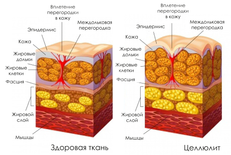 5 самых эффективных упражнений для борьбы с целлюлитом