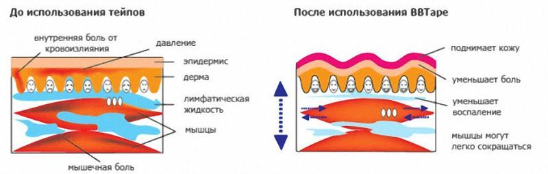 Кинезиотейпинг: олимпийский метод обезболивания растяжения связок