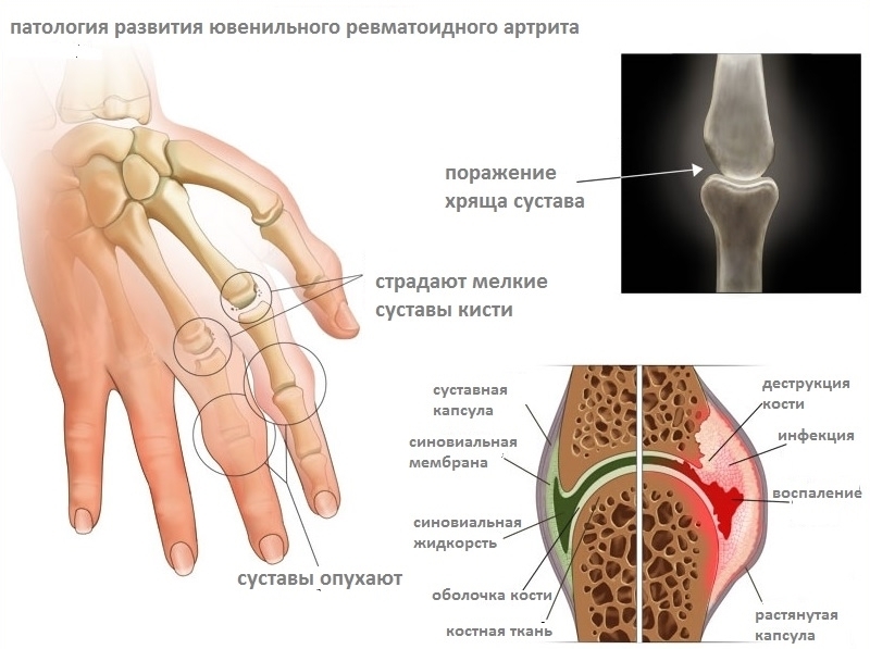 ВНИМАНИЕ! 7 ранних признаков артрита