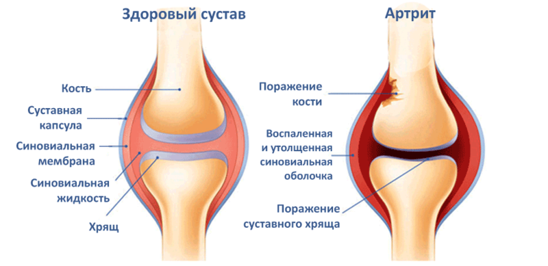 ВНИМАНИЕ! 7 ранних признаков артрита