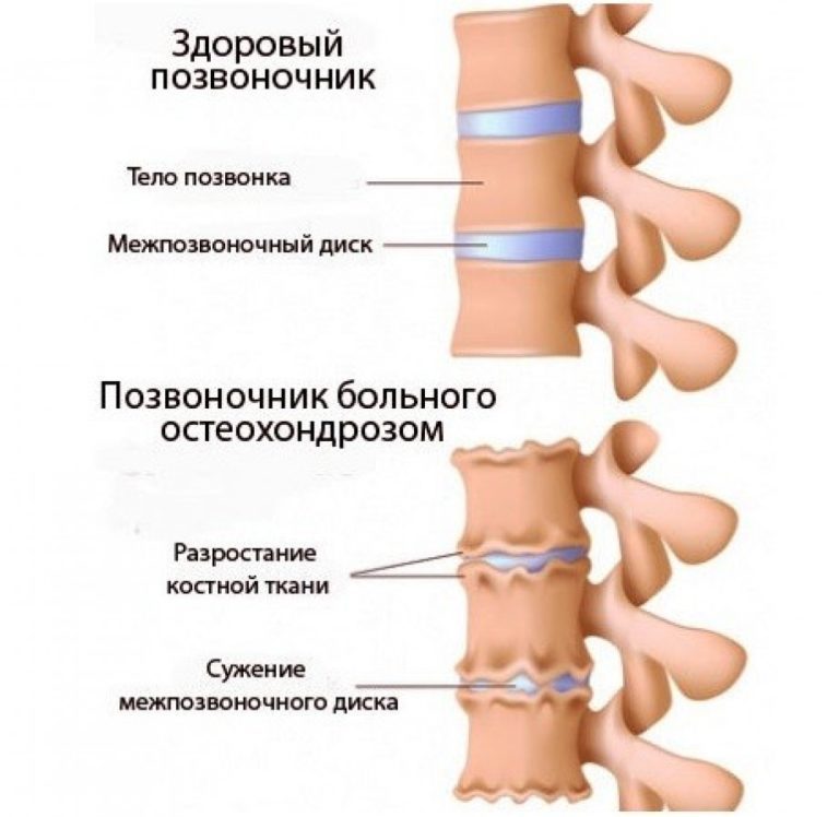 О чем говорит хруст в суставах