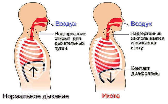 Полезные упражнения при ахиллобурсите и спазме грушевидной мышцы