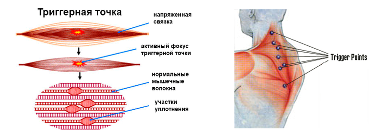 Отраженная боль: что ВАЖНО знать о триггерных точках