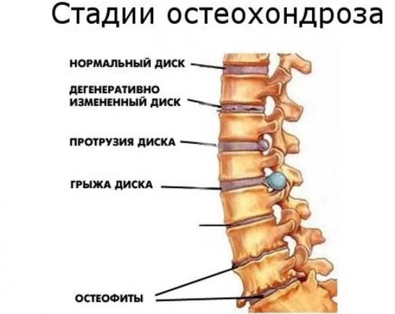 Протрузии позвоночника: упражнения, которые может сделать каждый