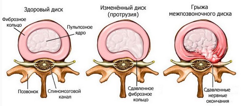 Упражнения, которые выручат при протрузии межпозвоночного диска