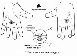 Волшебные точки для избавления от геморроя