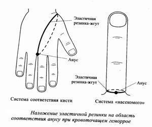 Волшебные точки для избавления от геморроя