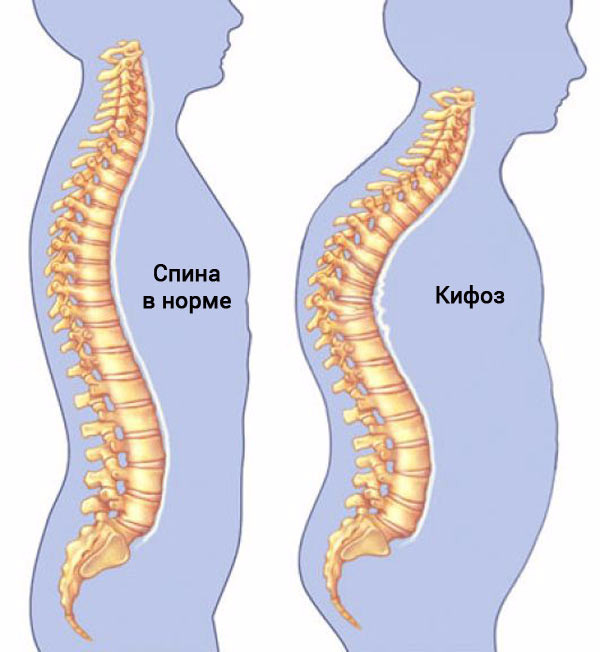 Упражнения при грудном кифозе