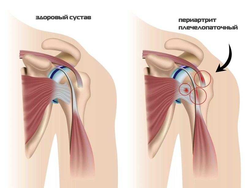 Упражнения при плечелопаточном периартрите