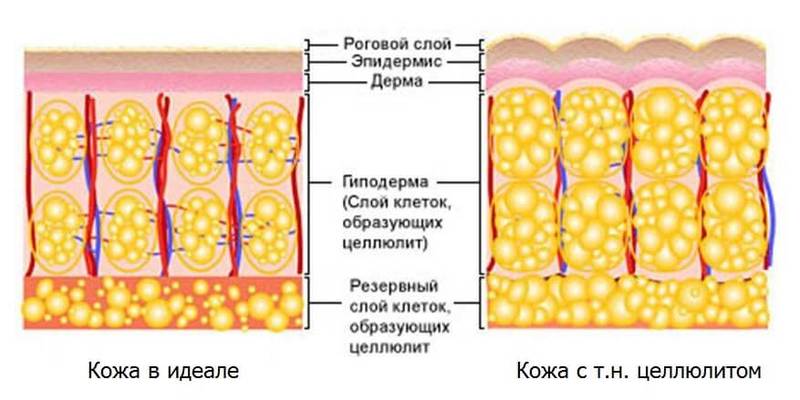 Целлюлит как самый великий всемирный обман