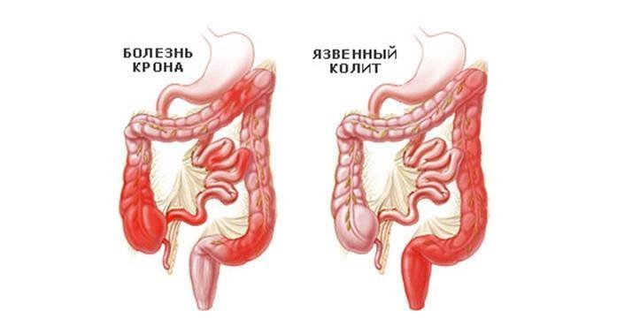 Основные причины, вызывающие вздутие живота