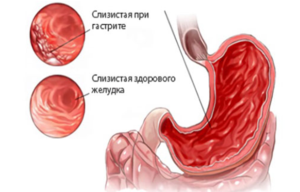 10 полезных упражнений при гастрите