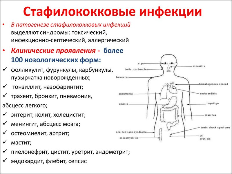 Стафилококк: эффективные рецепты народной медицины