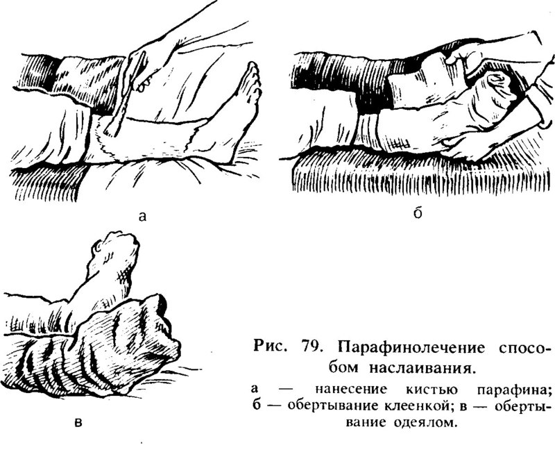 Эта процедура полезна при артрите, трофических язвах и не только