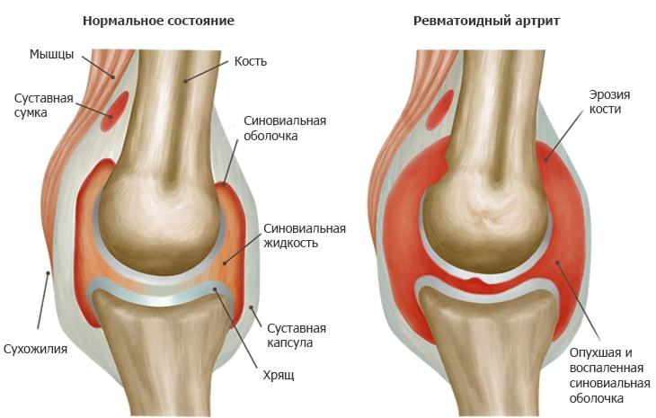 Ревматоидный артрит: комплексные рекомендации по лечению 