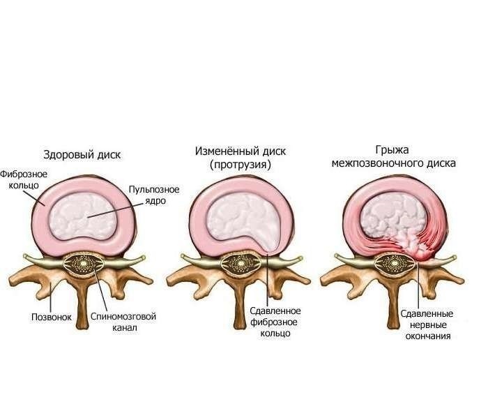 Упражнения для спины при грыже межпозвонкового диска