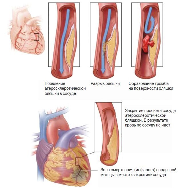 Что происходит с организмом во время сердечного приступа?