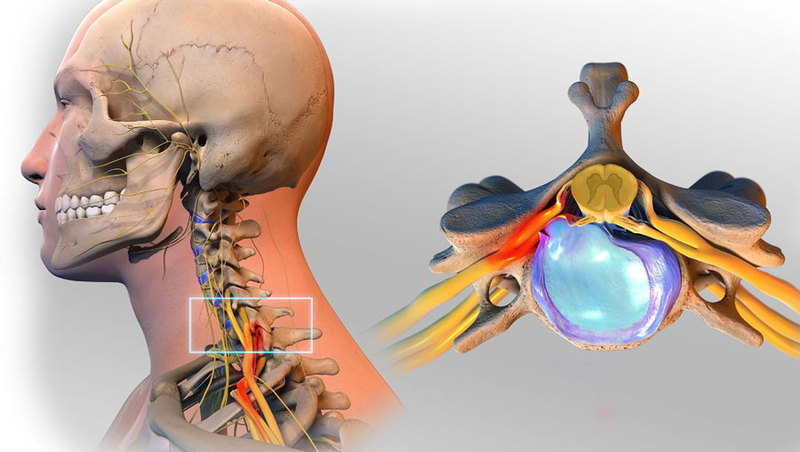 Эффективные упражнения при грыже шейного отдела позвоночника