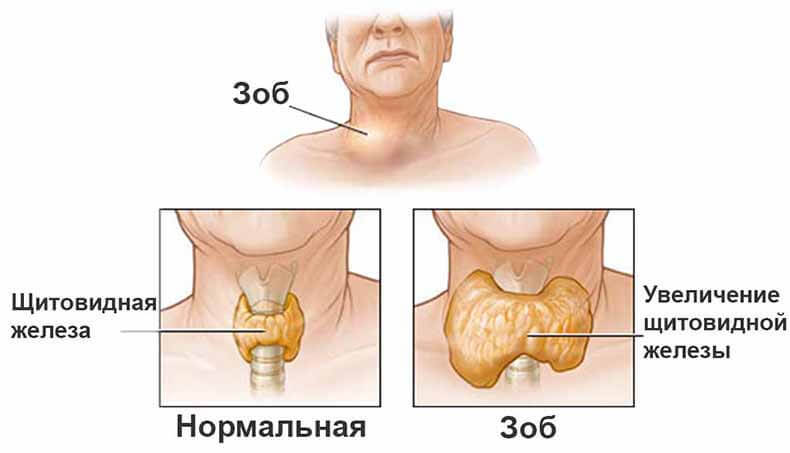 Тупик эндокринологии: Причины заболевания щитовидной железы