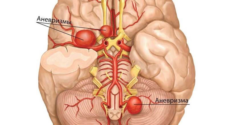 Чем опасна АНЕВРИЗМА и кому она грозит