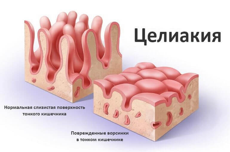 Чувствительность к глютену: Как пшеница влияет на здоровье