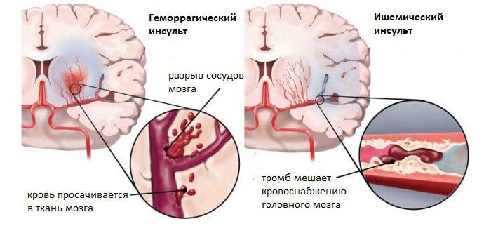 ВАЖНО! Как распознать инсульт