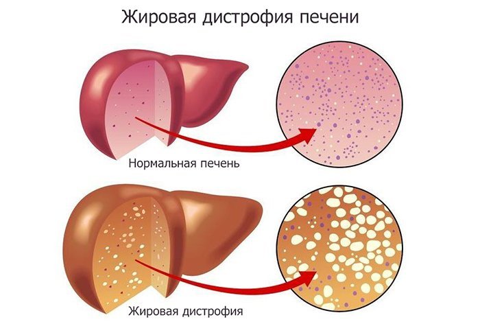 5 натуральных настоев при ожирении печени