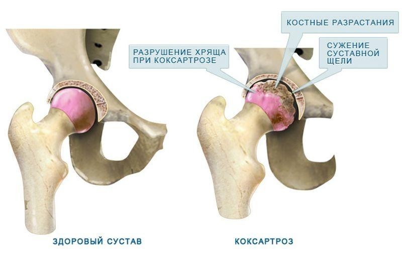 ЛЕЧЕБНЫЙ комплекс суставной гимнастики при коксартрозе