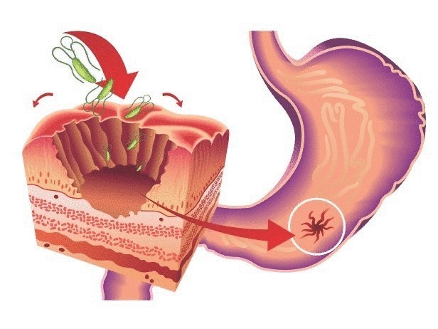 Причины и первые признаки возникновения язвы желудка