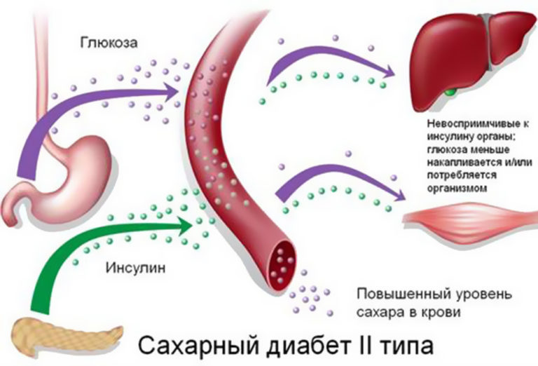 КАК вылечить диабет 2-го типа БЕЗ медикаментов!