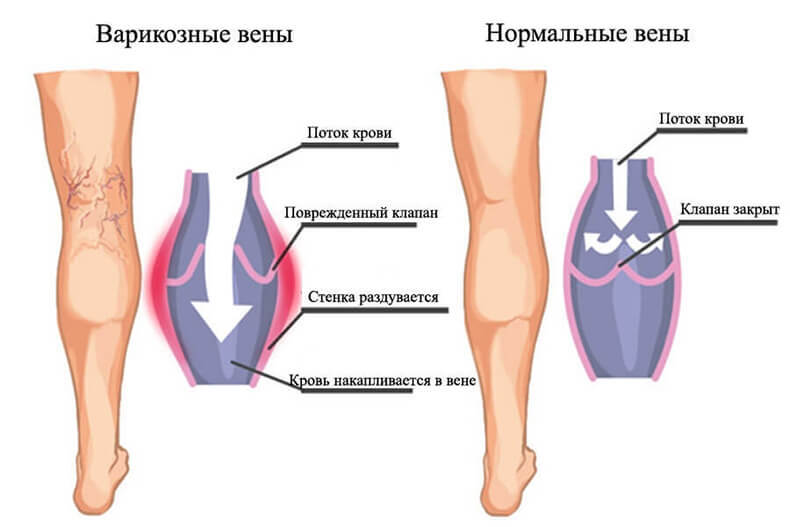 Варикозное расширение вен: упражнения Микулина