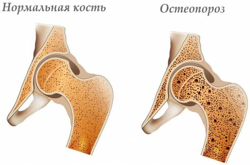 Правда об остеопорозе