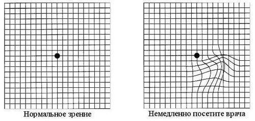 Тест Амслера: как вовремя выявить заболевание глаз